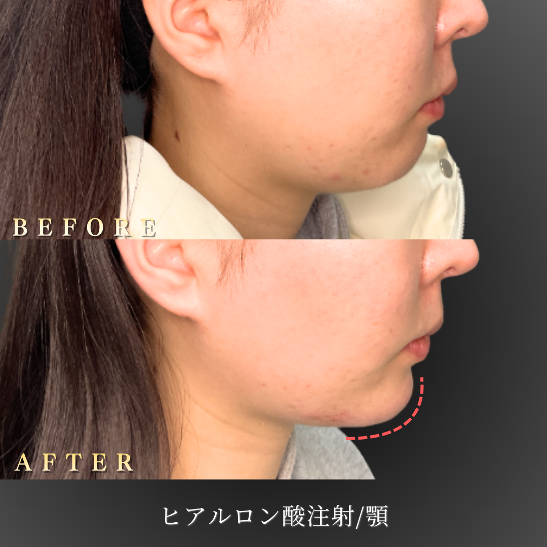 【20代女性】Eラインを自然に整える顎ヒアルロン酸症例｜大阪 心斎橋BiBiクリニックの症例写真