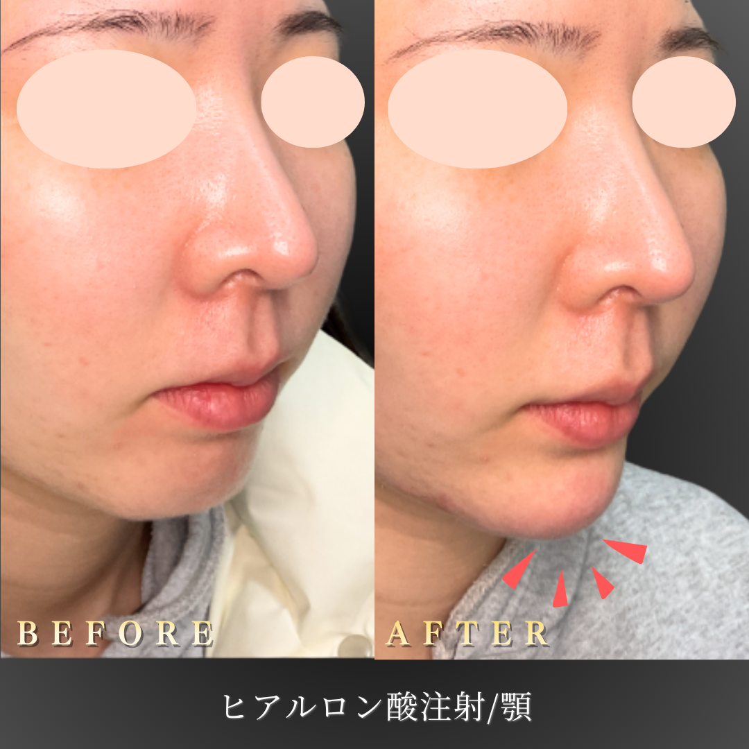 20代 顎ヒアルロン酸 症例写真〔左45度Before/After〕｜大阪 心斎橋BiBiクリニック