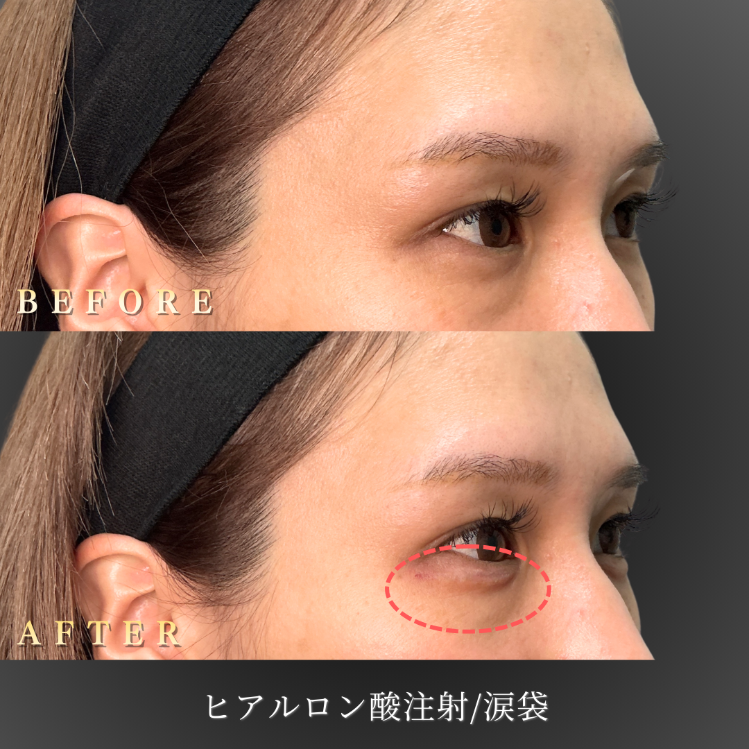 30代 涙袋ヒアルロン酸 症例写真〔右45度Before/After〕｜大阪 心斎橋BiBiクリニック