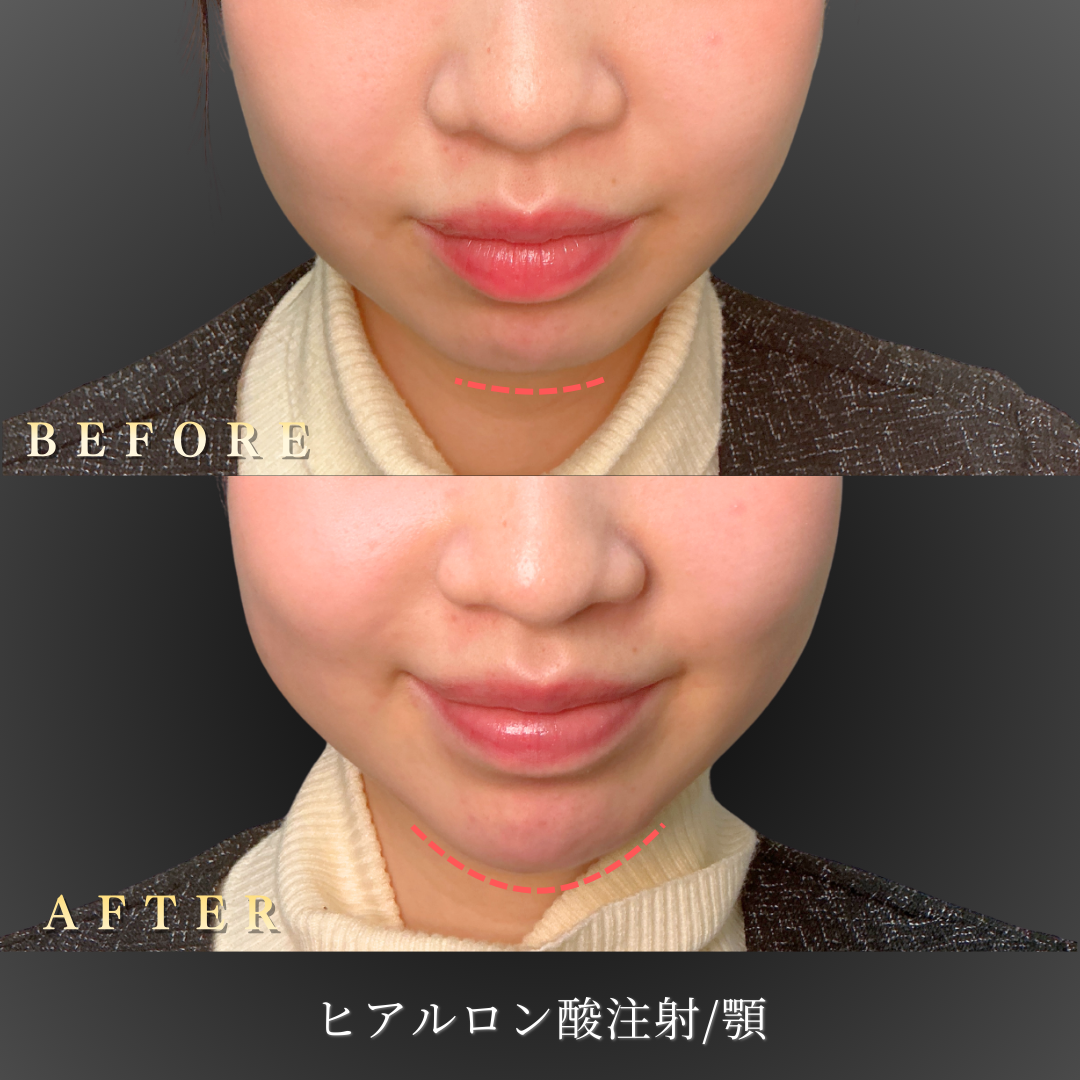 20代 顎ヒアルロン酸 症例写真〔正面笑顔Before/After〕｜大阪 心斎橋BiBiクリニック