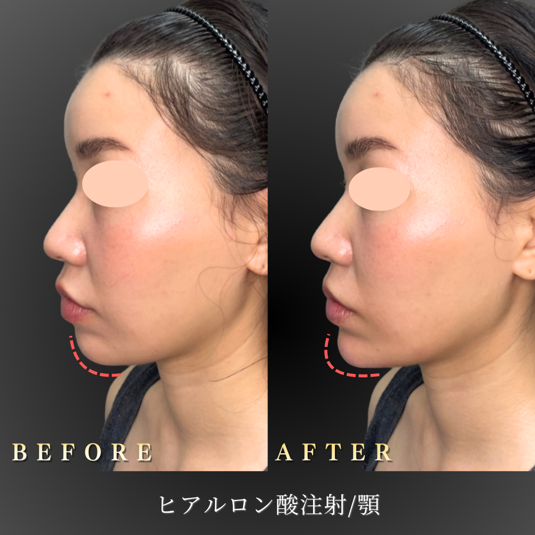 30代 顎ヒアルロン酸 症例写真〔左横Before/After〕｜大阪 心斎橋BiBiクリニック