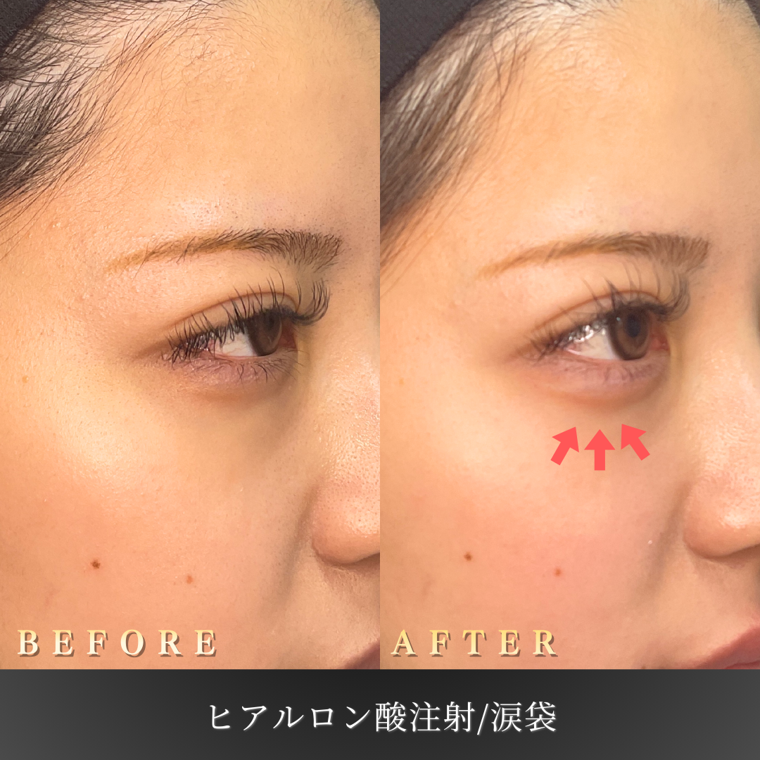 20代 涙袋ヒアルロン酸 症例写真〔右45度Before/After〕｜大阪 心斎橋BiBiクリニック