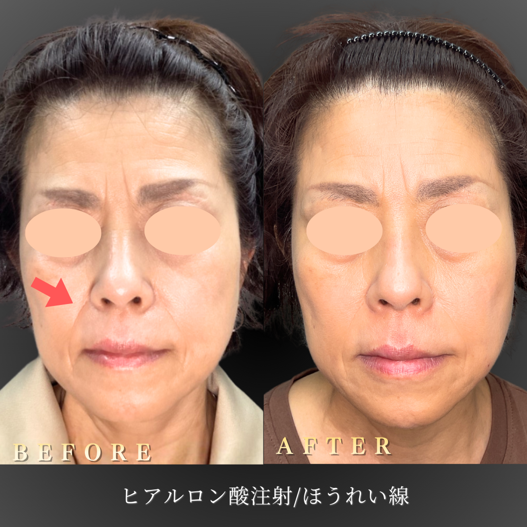 50代 マリオネットライン ヒアルロン酸 症例写真〔Before〕｜大阪 心斎橋BiBiクリニック
