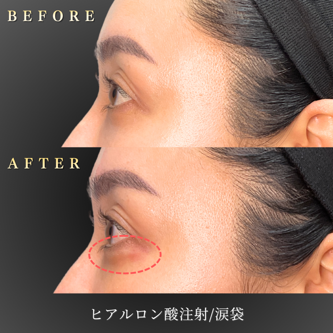 40代 涙袋ヒアルロン酸 症例写真〔左横Before/After〕｜大阪 心斎橋BiBiクリニック