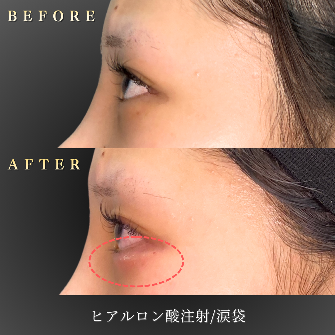 10代女性 涙袋ヒアルロン酸 症例写真〔左横Before/After〕｜大阪 心斎橋BiBiクリニック