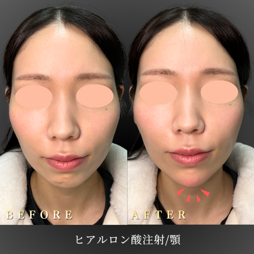 20代女性 顎ヒアルロン酸 症例写真〔正面Before/After〕｜大阪 心斎橋BiBiクリニック