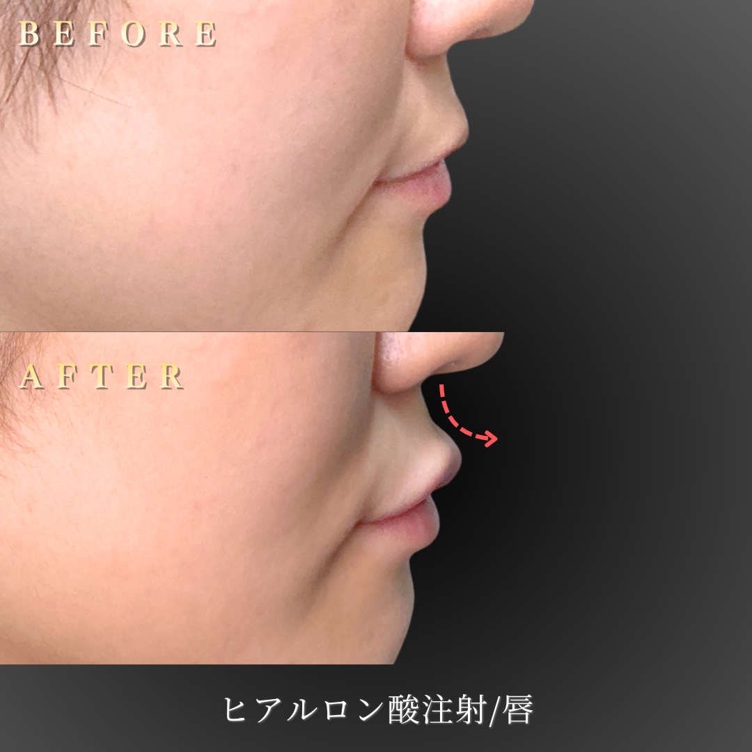 20代女性 唇ヒアルロン酸 ナチュラル 症例写真〔横顔〕｜大阪 心斎橋BiBiクリニック