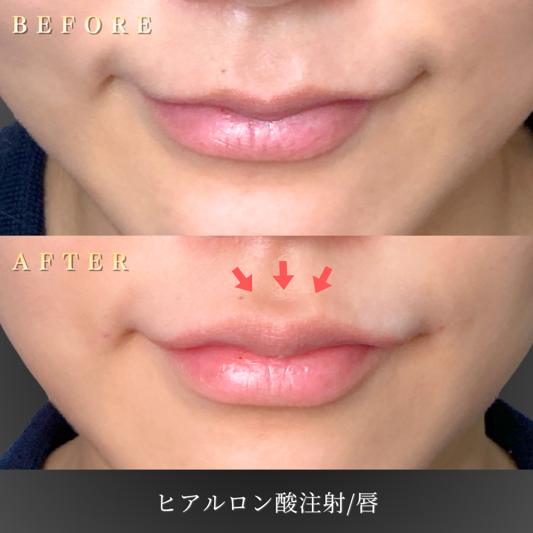 20代女性 唇ヒアルロン酸 ナチュラル 症例写真〔Before/After〕｜大阪 心斎橋BiBiクリニック