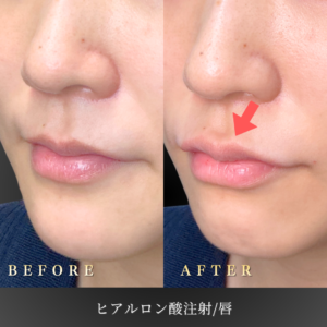 20代 唇ヒアルロン酸 症例写真〔左45度Before/After〕｜大阪 心斎橋BiBiクリニック
