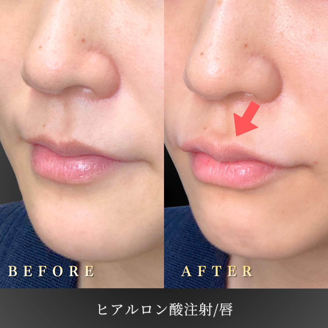 20代女性 唇ヒアルロン酸 ナチュラル 症例写真〔正面〕｜大阪 心斎橋BiBiクリニック
