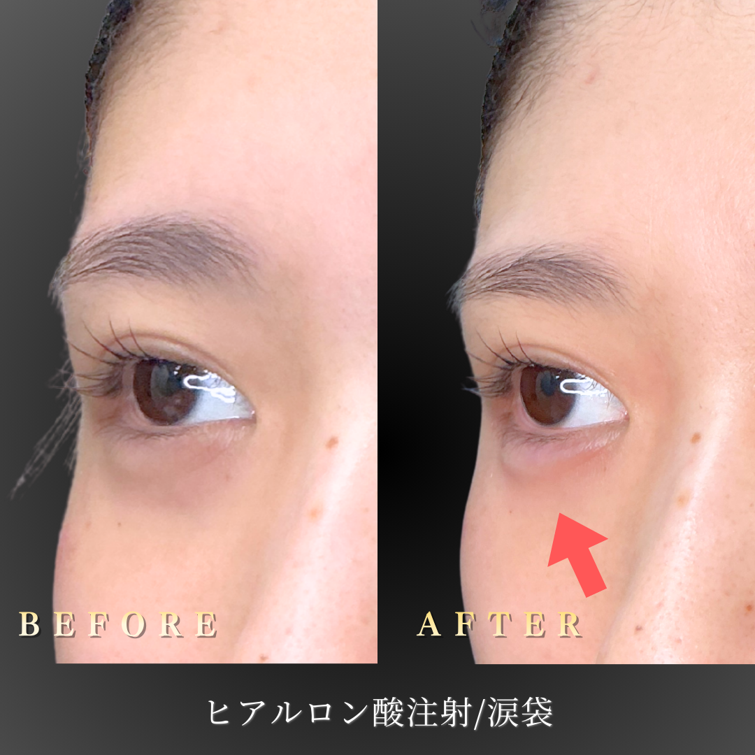 涙袋ヒアルロン酸注入による自然な立体感の変化