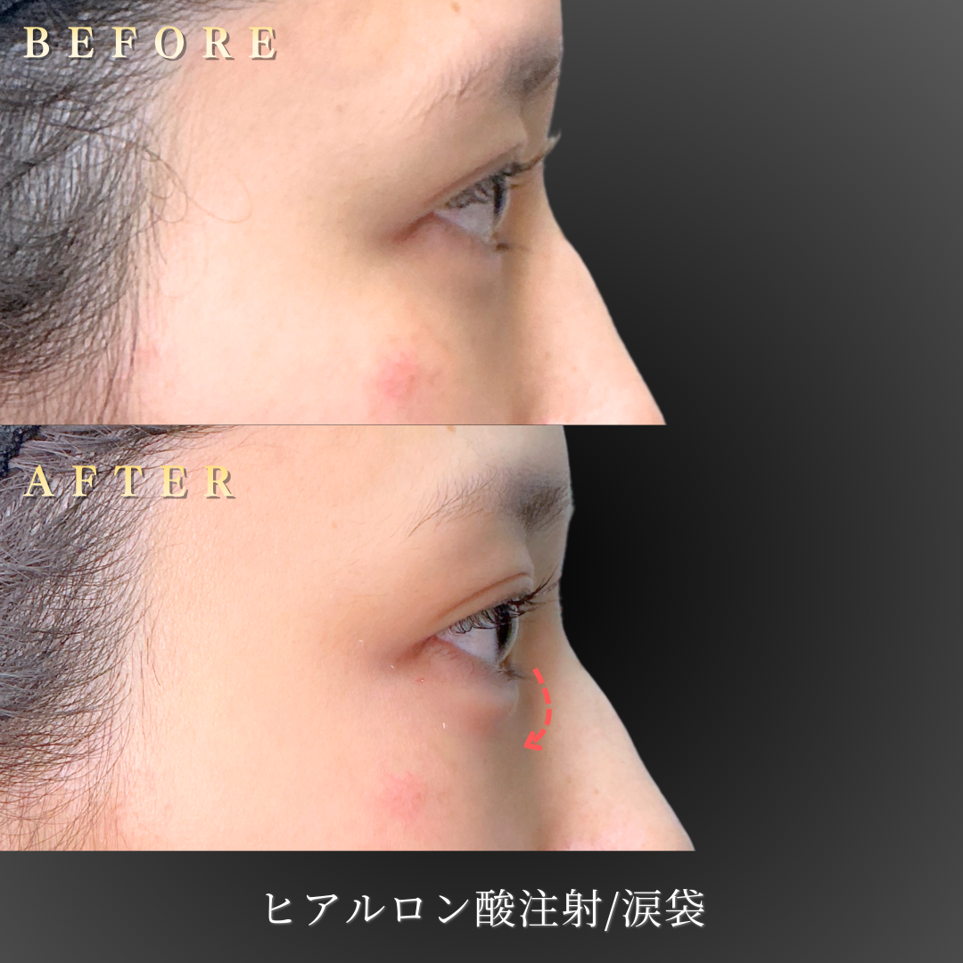 涙袋ヒアルロン酸施術前の20代女性患者様
