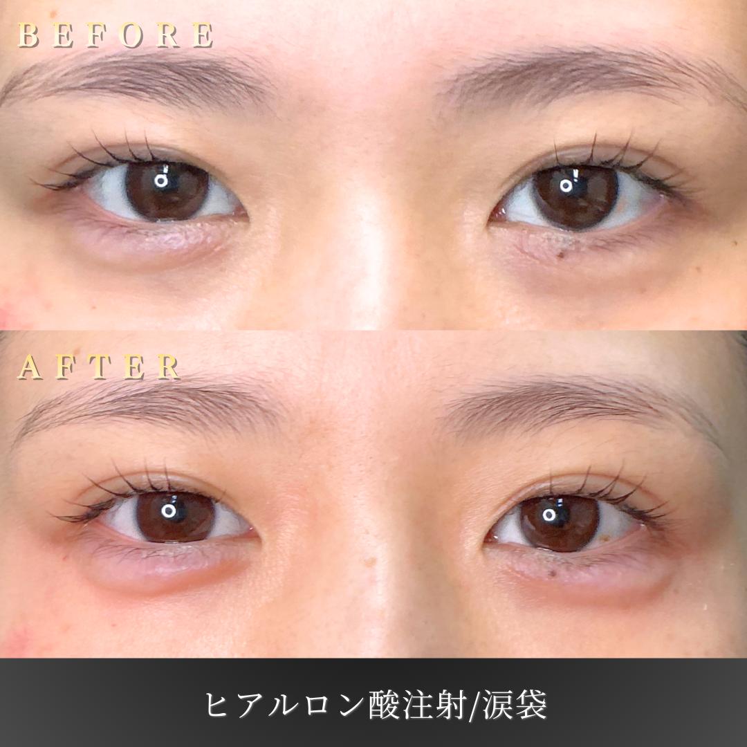 【20代女性】自然な立体感を作る涙袋ヒアルロン酸症例｜大阪 心斎橋BiBiクリニックの症例写真