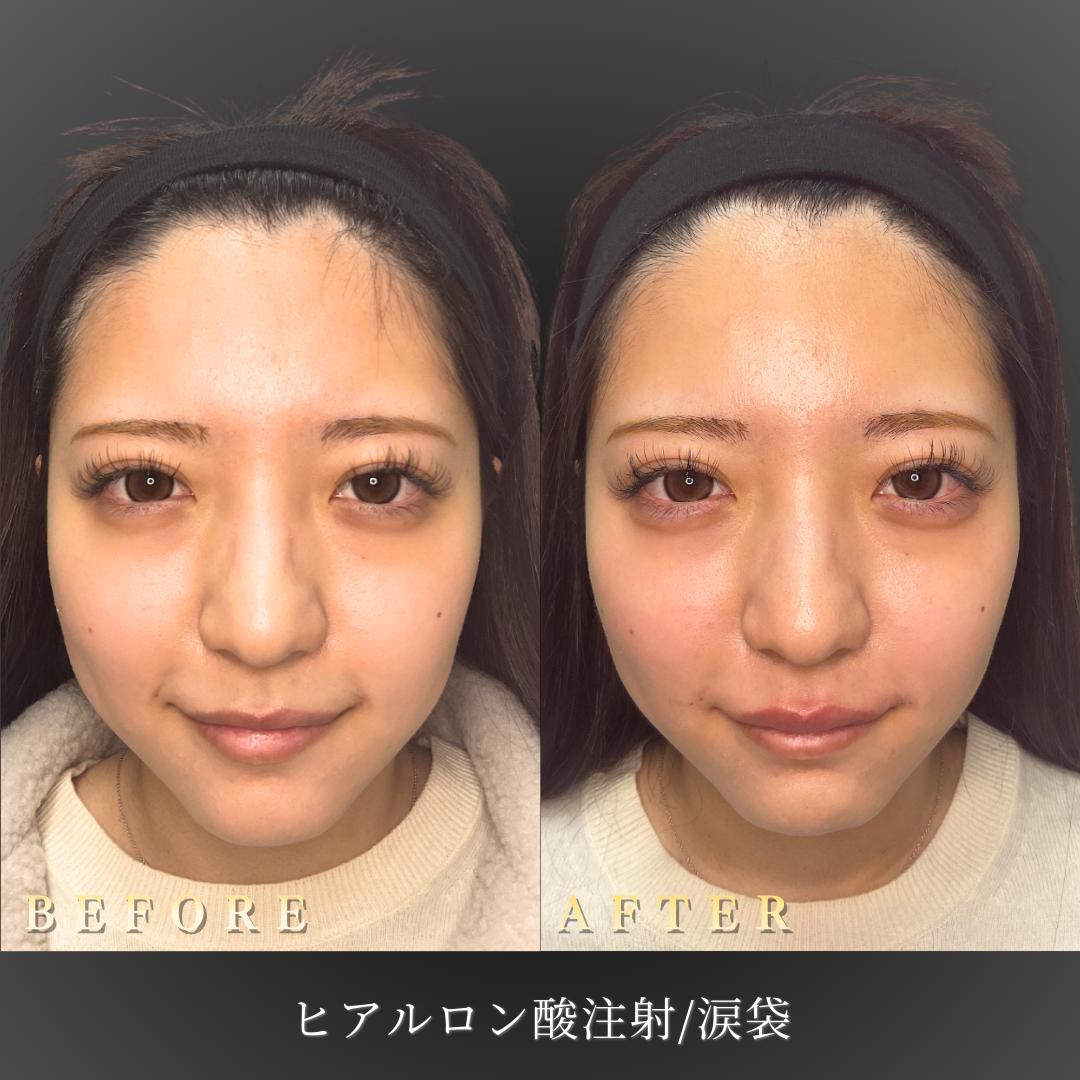 20代女性 涙袋ヒアルロン酸 症例写真〔正面笑顔Before/After〕｜大阪 心斎橋BiBiクリニック