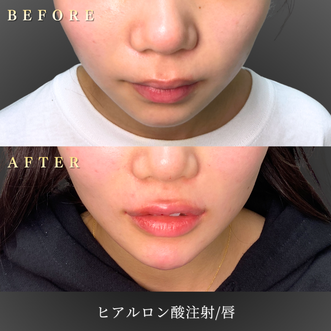 10代 唇ヒアルロン酸 症例写真〔正面Before/After〕｜大阪 心斎橋BiBiクリニック