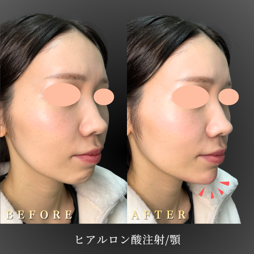 20代女性 顎ヒアルロン酸 症例写真〔右45度Before/After〕｜大阪 心斎橋BiBiクリニック