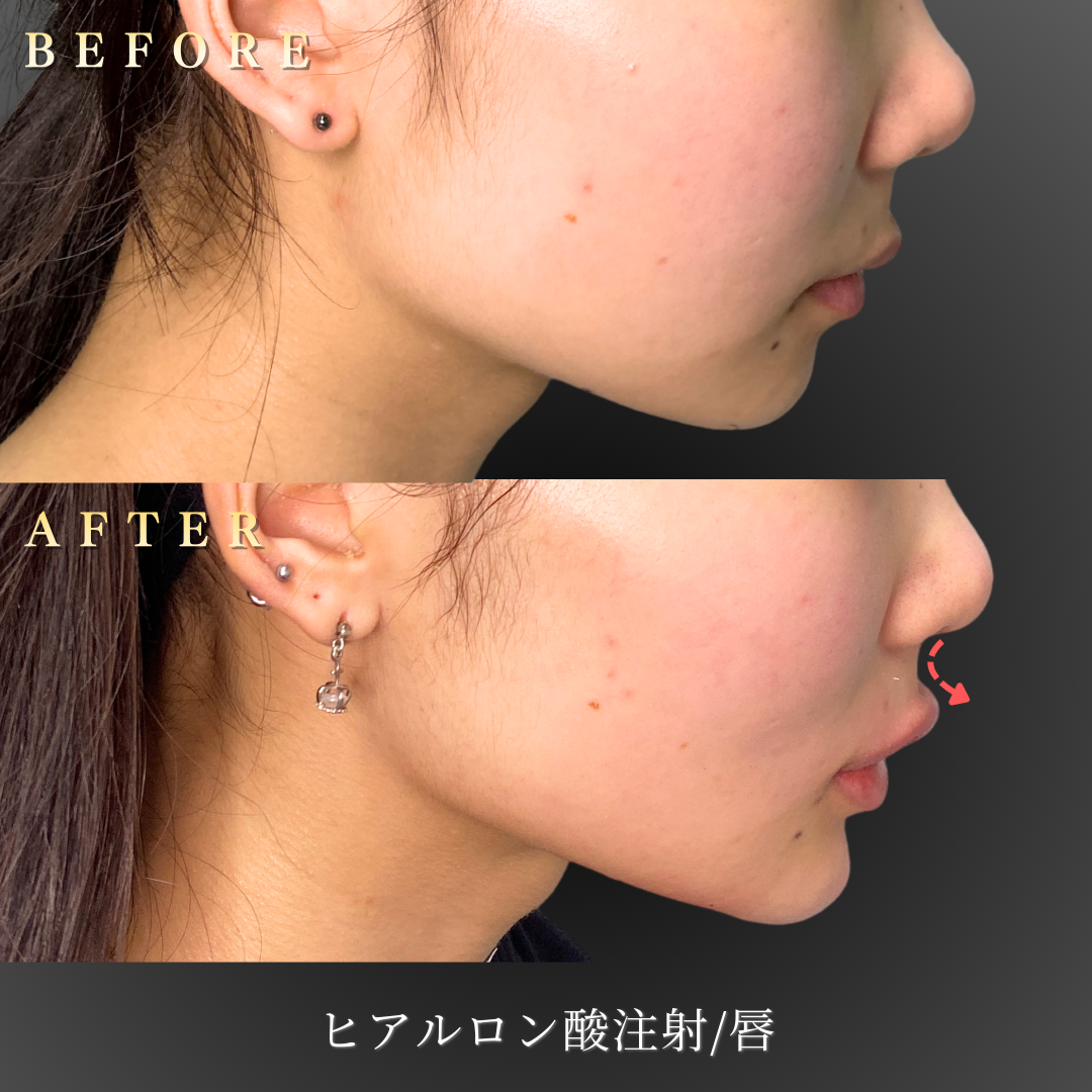 【10代女性】口元の印象を整える唇ヒアルロン酸症例｜大阪 心斎橋BiBiクリニックの症例写真