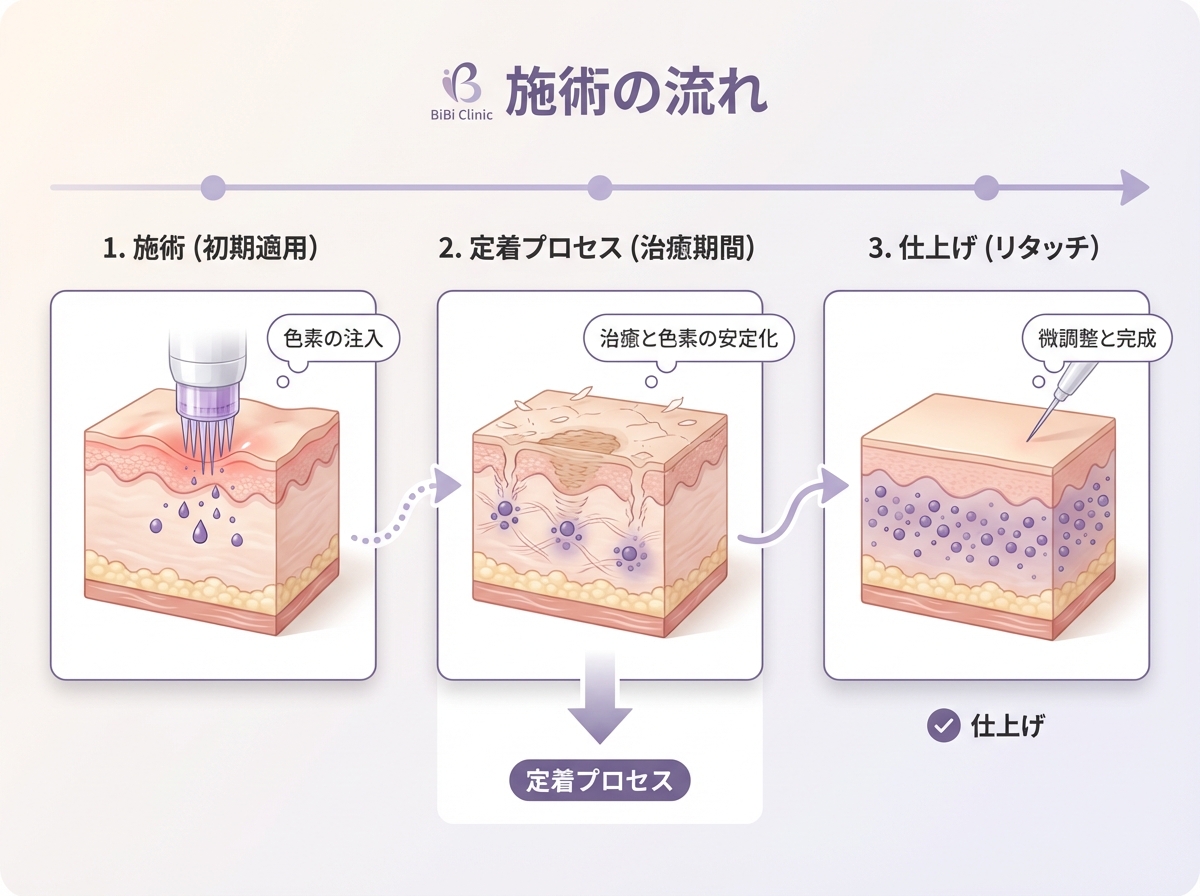 医療アートメイクの施術回数と色素定着プロセスを示す医学的イラスト