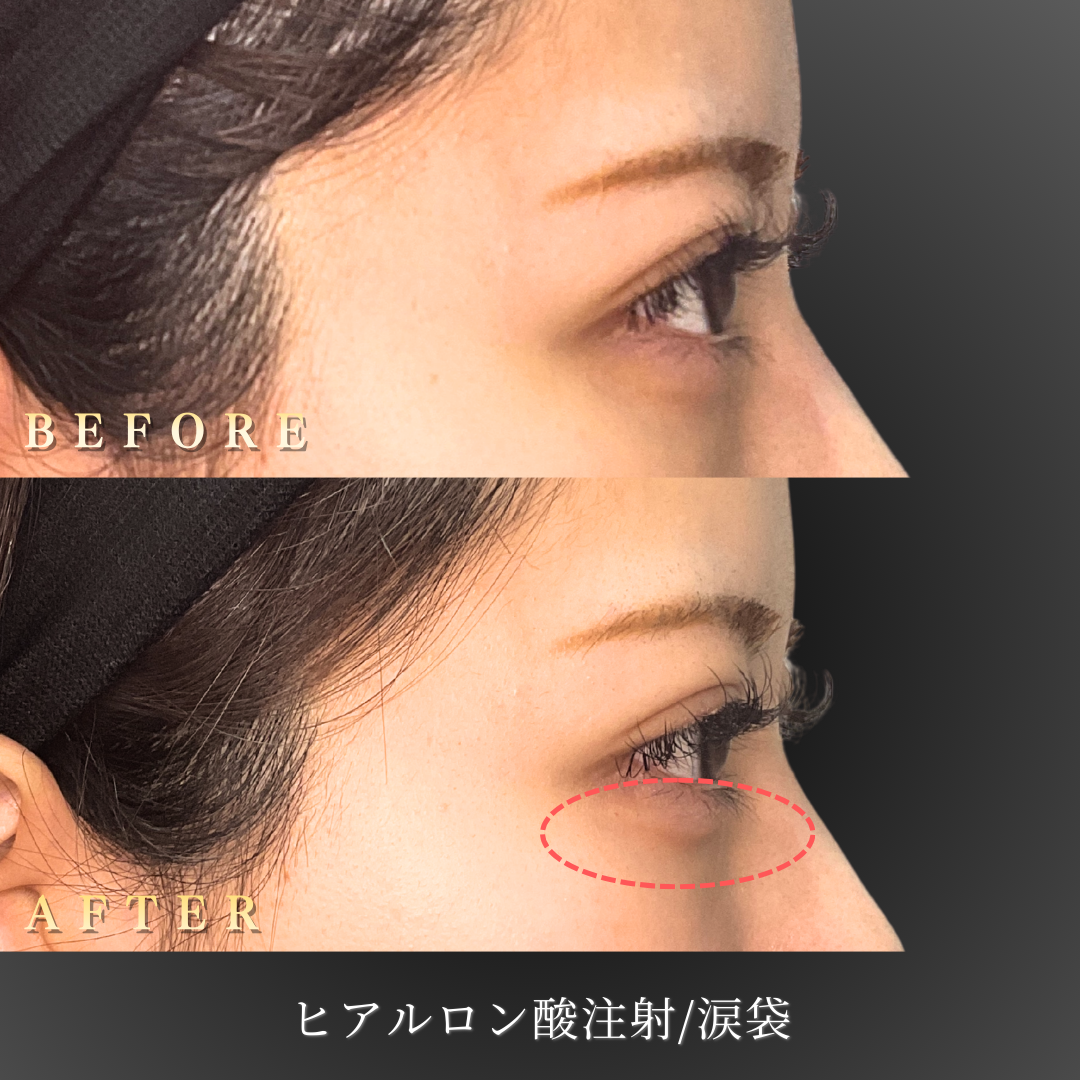 20代 涙袋ヒアルロン酸 症例写真〔右横Before/After〕｜大阪 心斎橋BiBiクリニック
