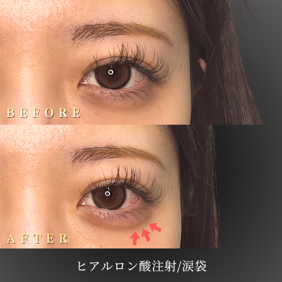 20代 涙袋ヒアルロン酸 症例写真〔正面Before/After〕｜大阪 心斎橋BiBiクリニック