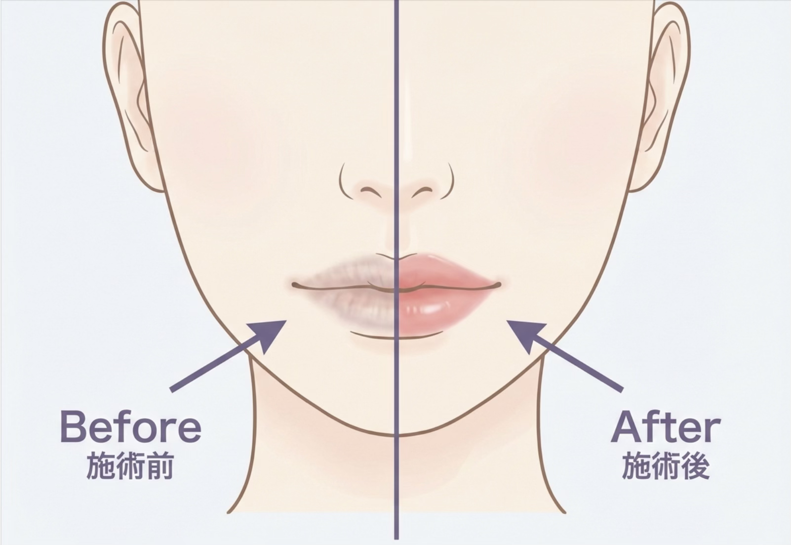 リップアートメイク｜血色と輪郭を整えるデザイン｜大阪・心斎橋 BiBiクリニック