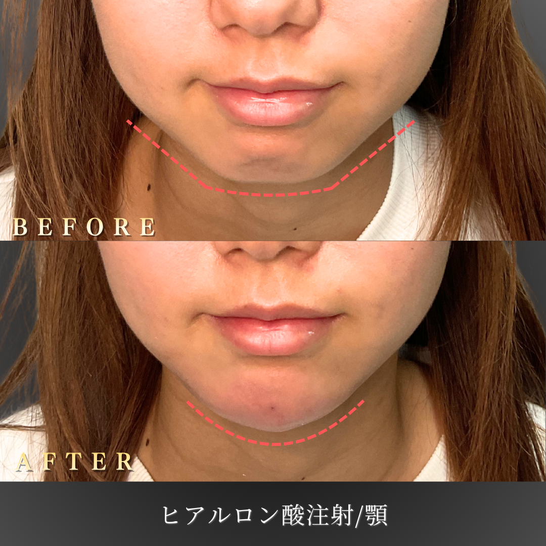 20代女性の顎ヒアルロン酸注入before/after写真