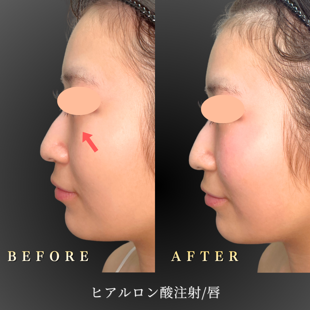 10代女性の中顔面ヒアルロン酸注入症例 ハリ感のある若々しい印象に変化したBefore/After写真