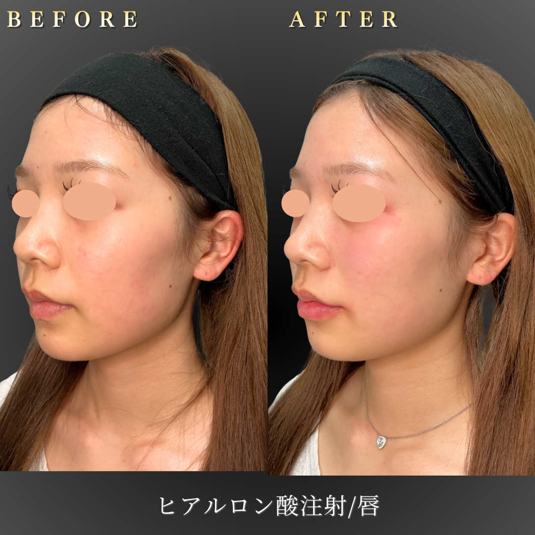 10代女性のリップヒアルロン酸施術左45度before/after写真