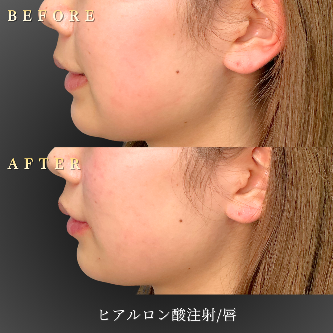 10代女性のリップヒアルロン酸施術左横before/after写真