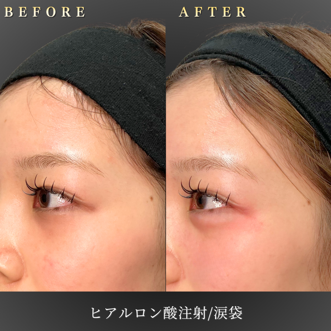 10代女性の涙袋ヒアルロン酸施術 左45度 ビフォーアフター