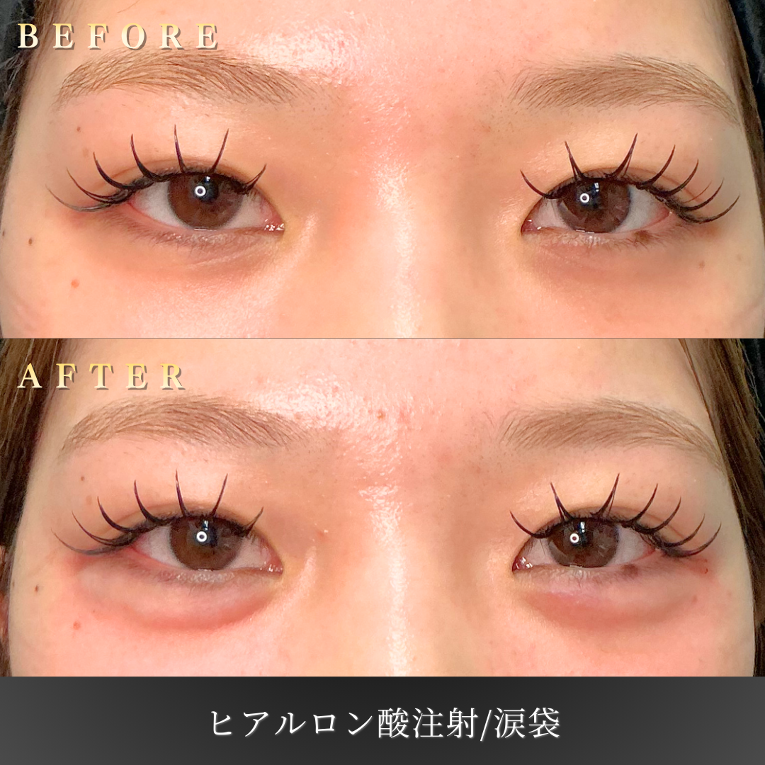 10代女性の涙袋ヒアルロン酸施術 正面 ビフォーアフター