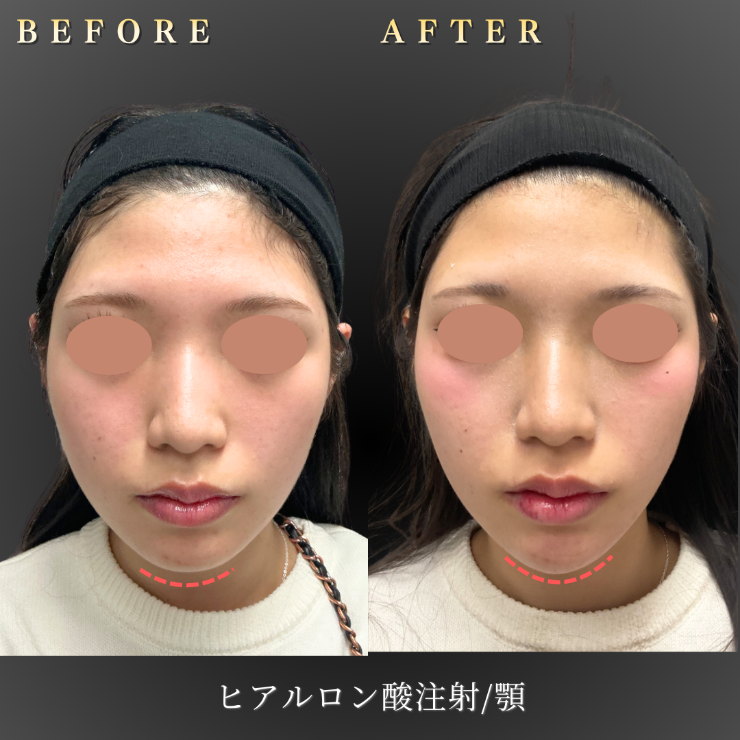10代女性の顎ヒアルロン酸施術 正面Before/After