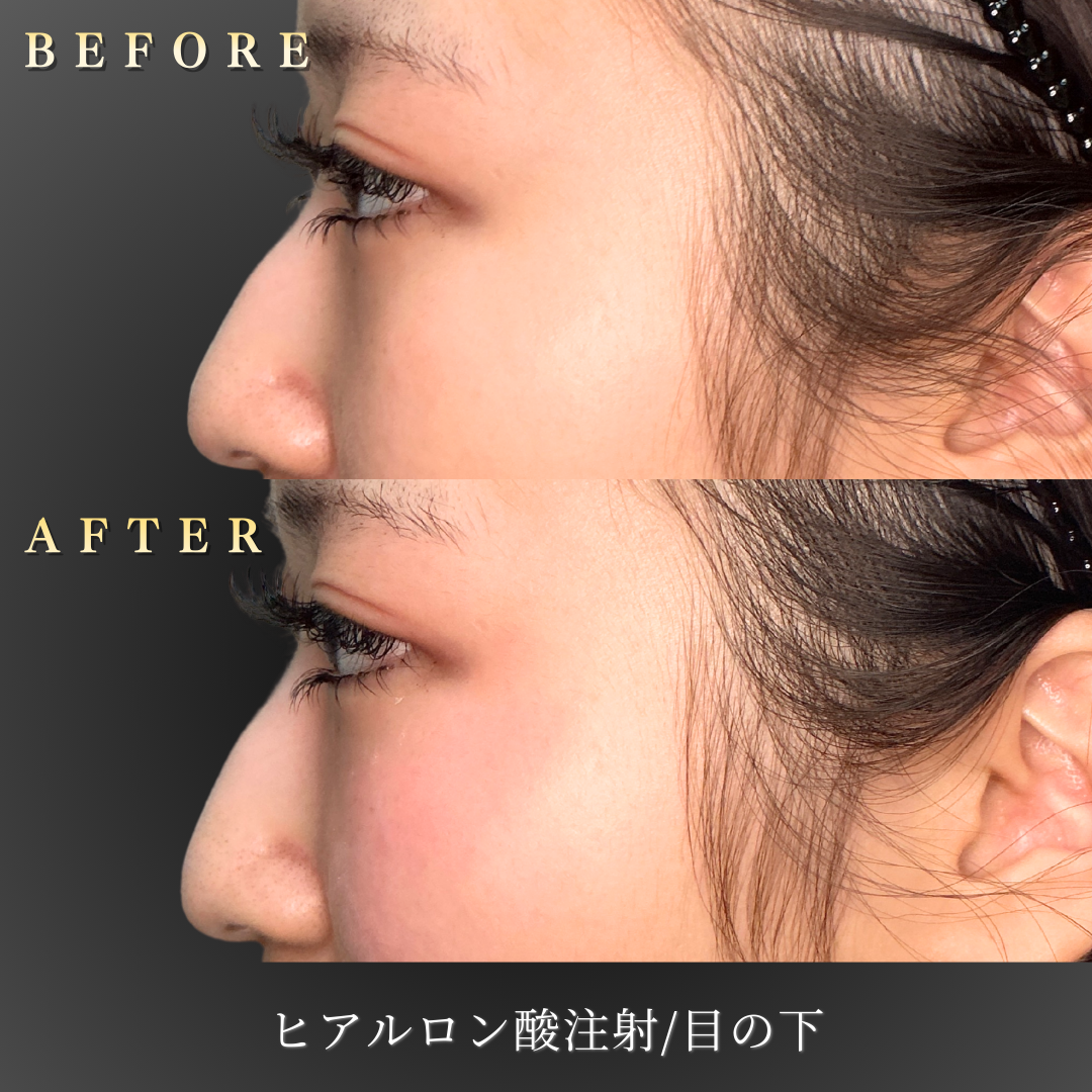 10代女性 ヒアルロン酸注入による中顔面の立体感回復の症例写真