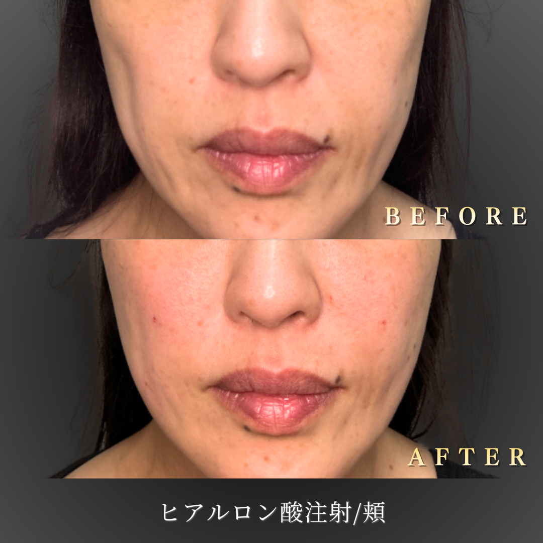 40ä»£å¥³æ§ã®é ¬ã®ããªã¥ã¼ã æ¹åãæ­£é¢ããã®å¤å