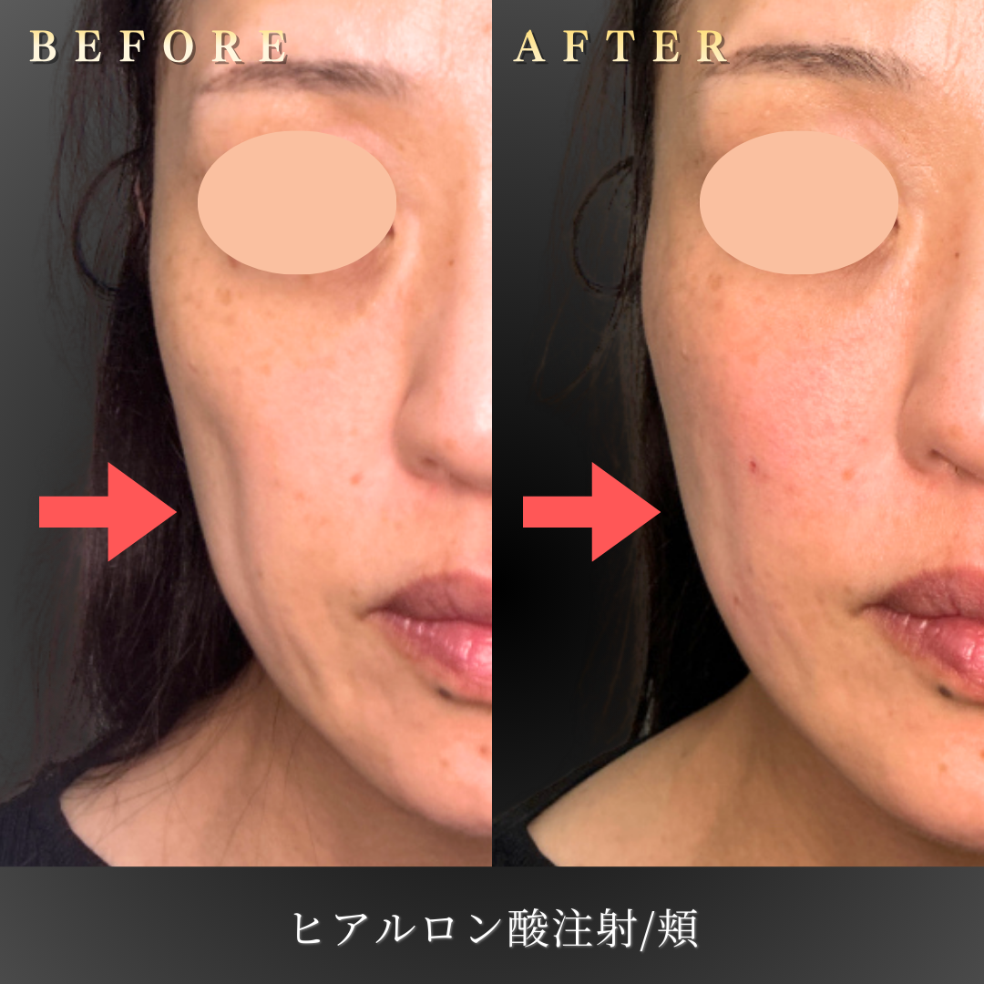 【40代女性】老け見えを防ぐ中顔面ヒアルロン酸症例｜大阪 心斎橋BiBiクリニックの症例写真