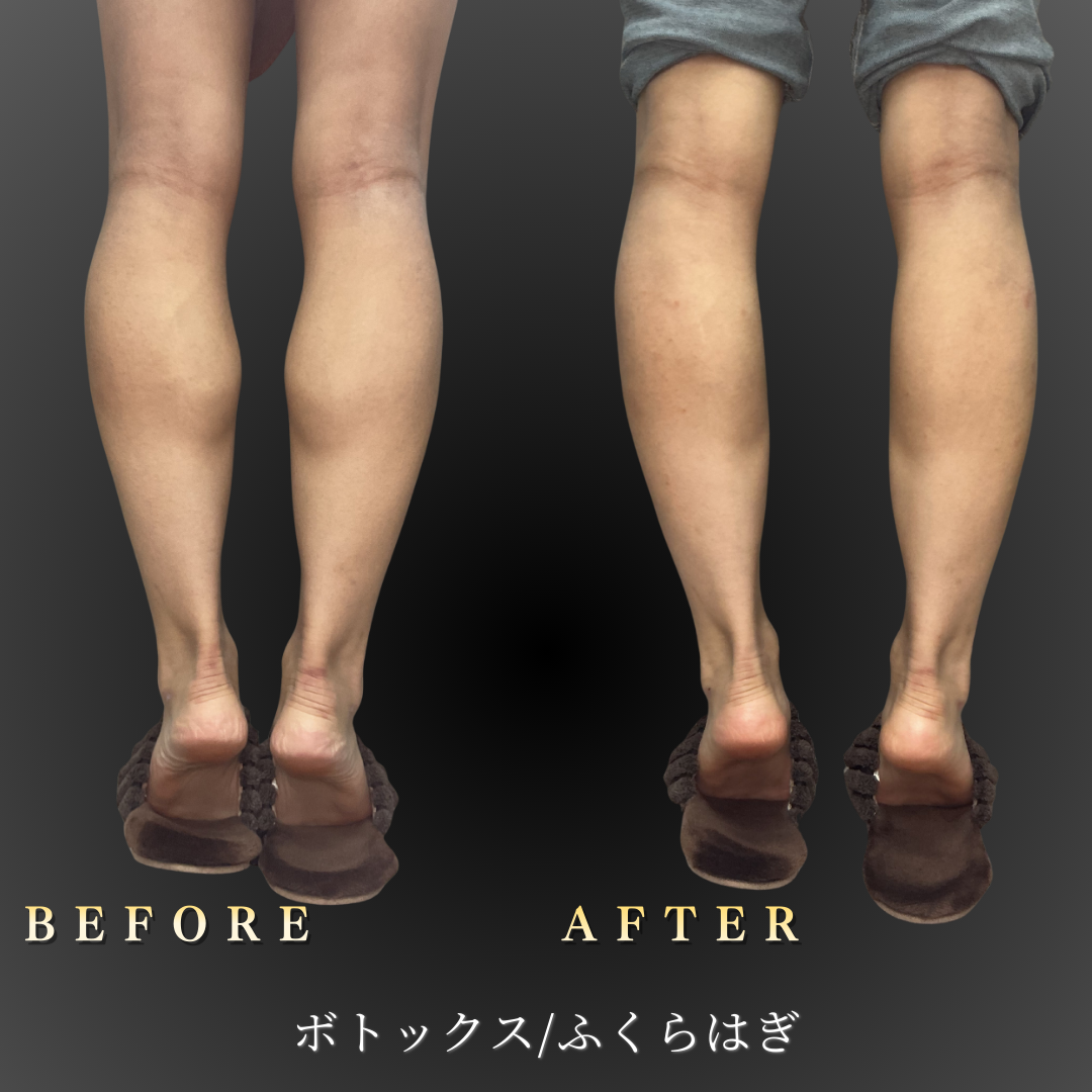 【20代女性】運動しても細くならない脚を整えるふくらはぎボトックス症例｜大阪 心斎橋BiBiクリニックの症例写真