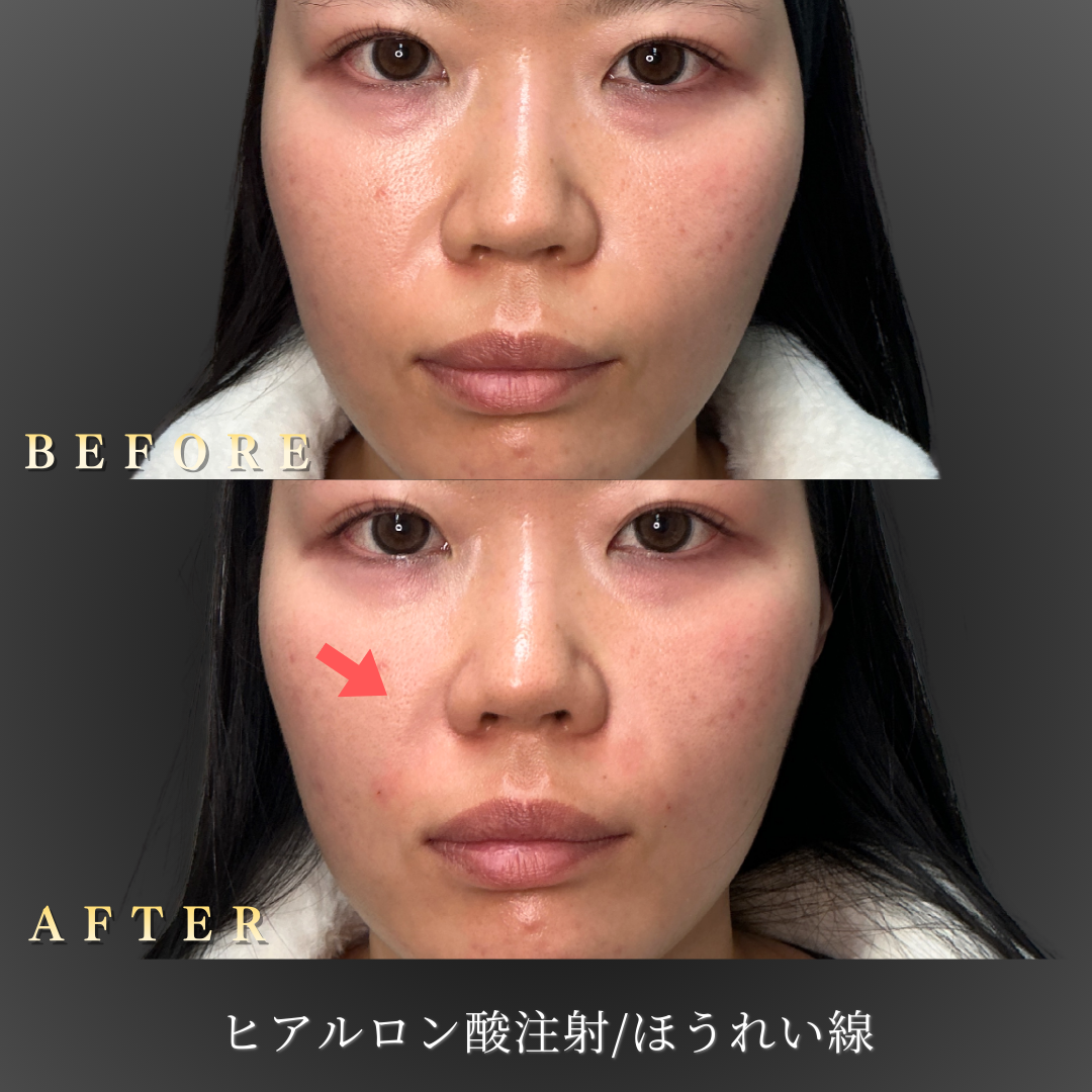 20代女性のほうれい線ヒアルロン酸注入施術前後の正面通常表情比較写真