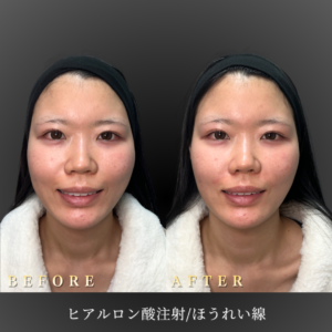 20代 ほうれい線ヒアルロン酸 症例写真〔正面笑顔Before_After〕｜大阪 心斎橋BiBiクリニック