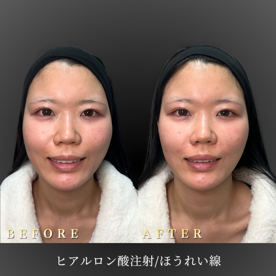 【20代女性】笑顔の線を自然に整える症例｜大阪 心斎橋BiBiクリニックの症例写真
