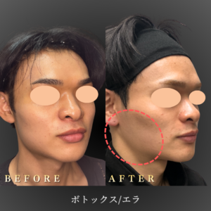 20代 エラボトックス 症例写真〔右45度Before_After〕｜大阪 心斎橋BiBiクリニック