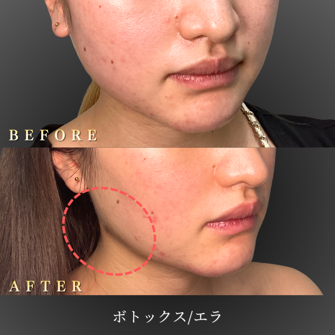 20代女性のエラボトックス施術前後の右45度写真