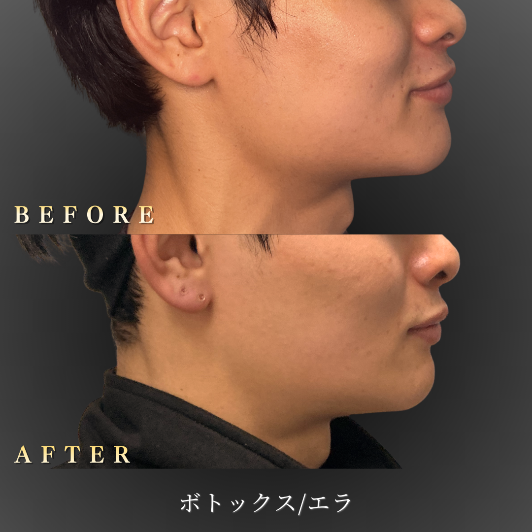 20代男性 エラボトックス 右横 Before/After｜大阪・心斎橋BiBiクリニック