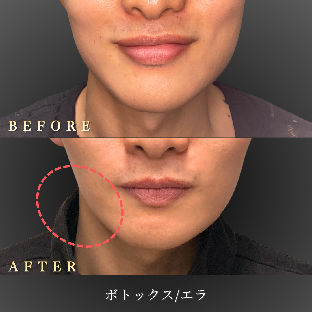 20代男性 エラボトックス 正面 Before/After｜大阪・心斎橋BiBiクリニック