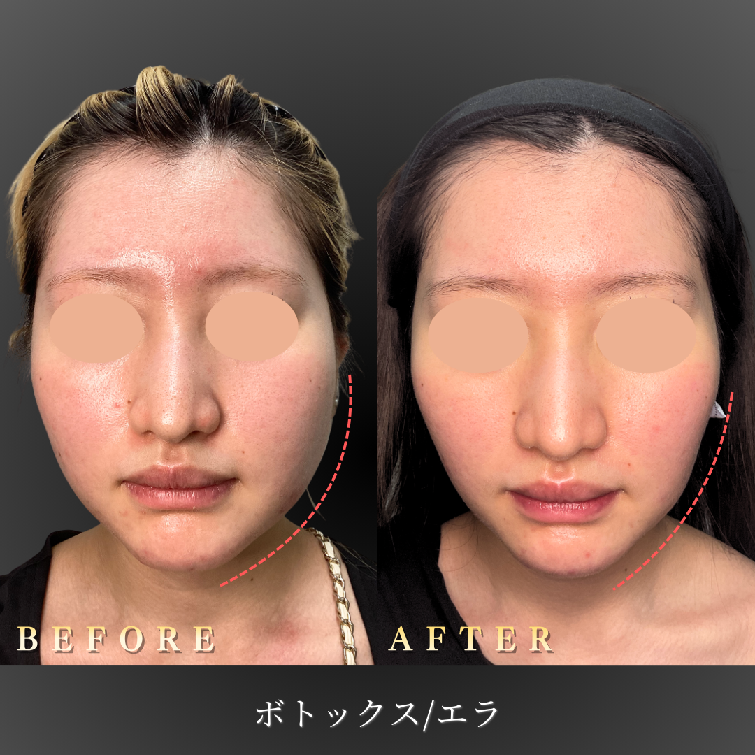 【20代女性】フェイスラインを整えるエラボトックス症例｜大阪 心斎橋BiBiクリニックの症例写真