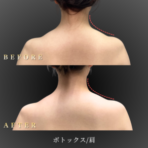 20代 ボトックス 症例写真〔背面BeforeAfter〕｜大阪 心斎橋BiBiクリニック