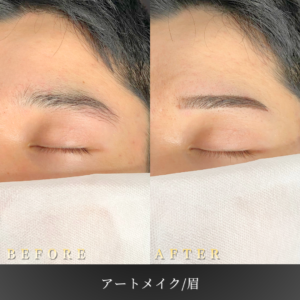 20代 眉アートメイク 症例写真〔正面笑顔BeforeAfter〕｜大阪 心斎橋BiBiクリニック