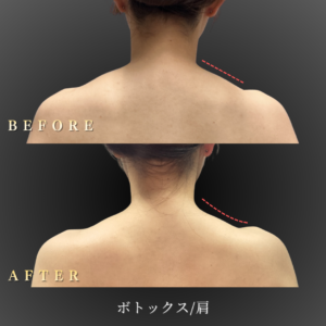 20代 肩ボトックス 症例写真〔表面BeforeAfter〕｜大阪 心斎橋BiBiクリニック