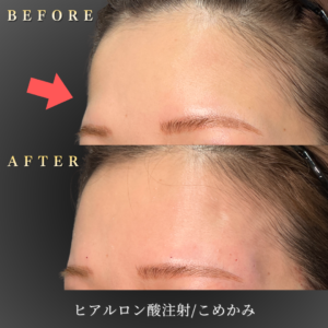 20代こめかみヒアルロン酸 症例写真〔左45度Before_After〕｜大阪 心斎橋BiBiクリニック