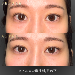 20代目の下ヒアルロン酸 症例写真〔正面Before_After〕｜大阪 心斎橋BiBiクリニック