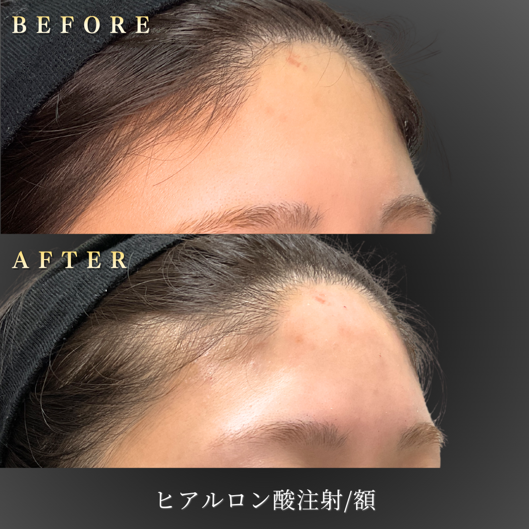 20代女性の額ヒアルロン酸施術の右45度Before/After写真